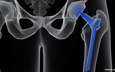 Are you opting for a Hip Replacement Surgery in Bhubaneswar?