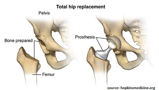 Are you option for a hip replacement surgery