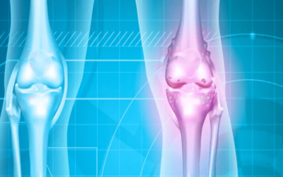 Types of Joint Replacement Surgeries