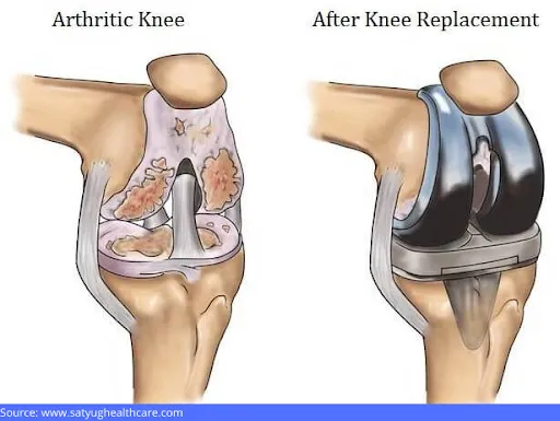Bilateral total knee arthroplasty