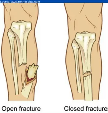 Closed fractures