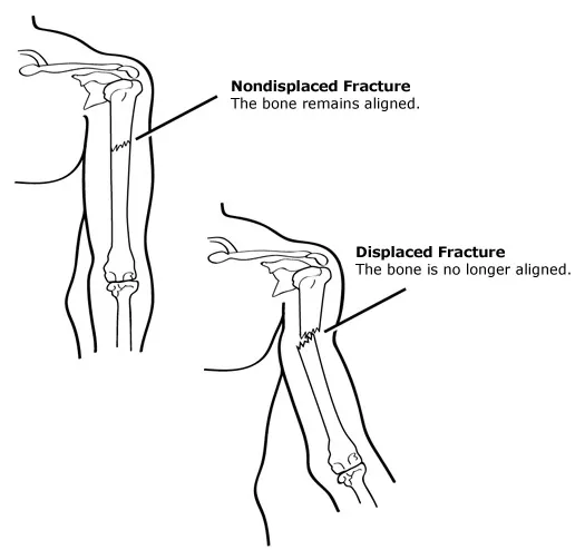 Displaced fracture