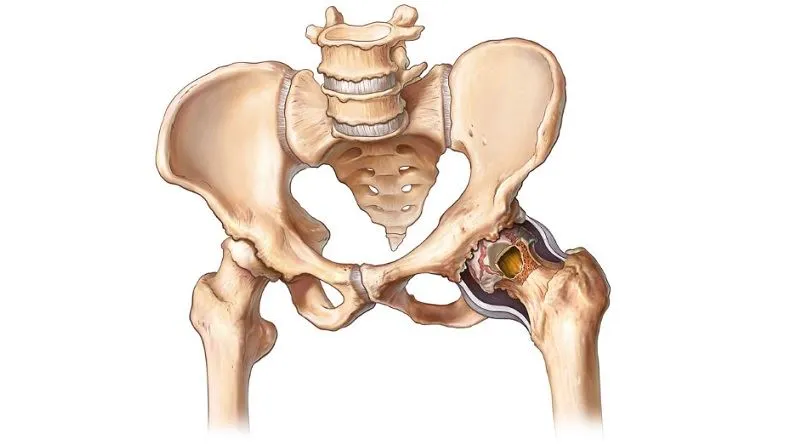 Hip reconstruction