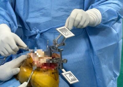 AI Knee replacement