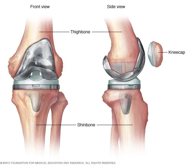 Results after a Knee Replacement