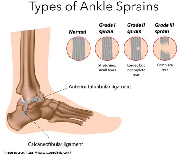 Tyoes OF ankle sprain