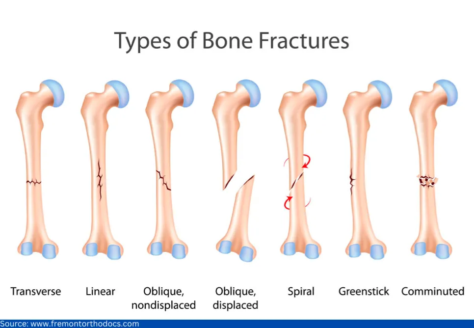 Types of bone Fractures