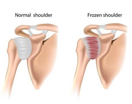  frozen shoulder