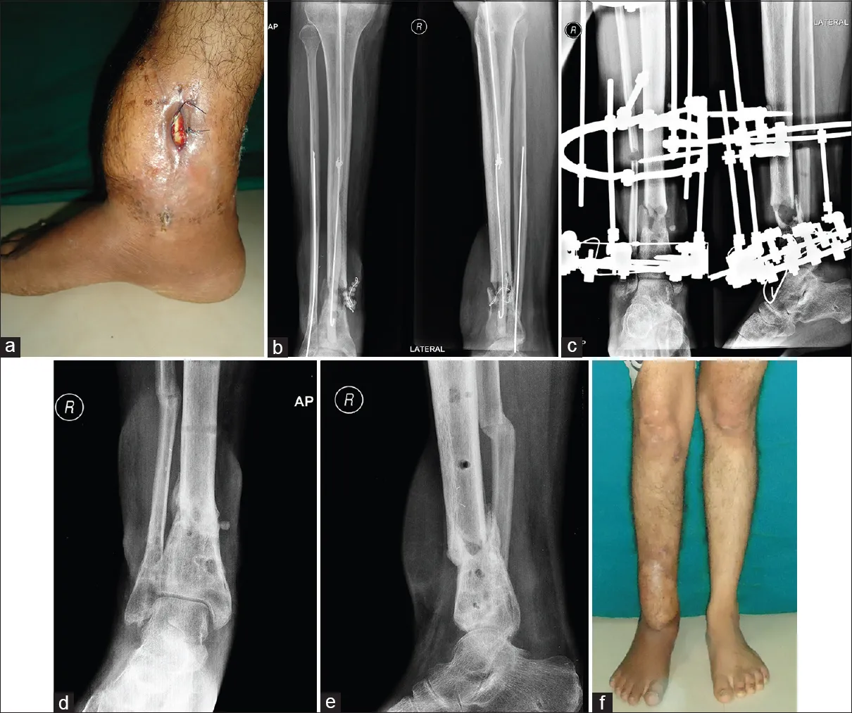 infected nonunion