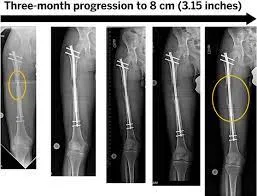 limb lengthening surgery