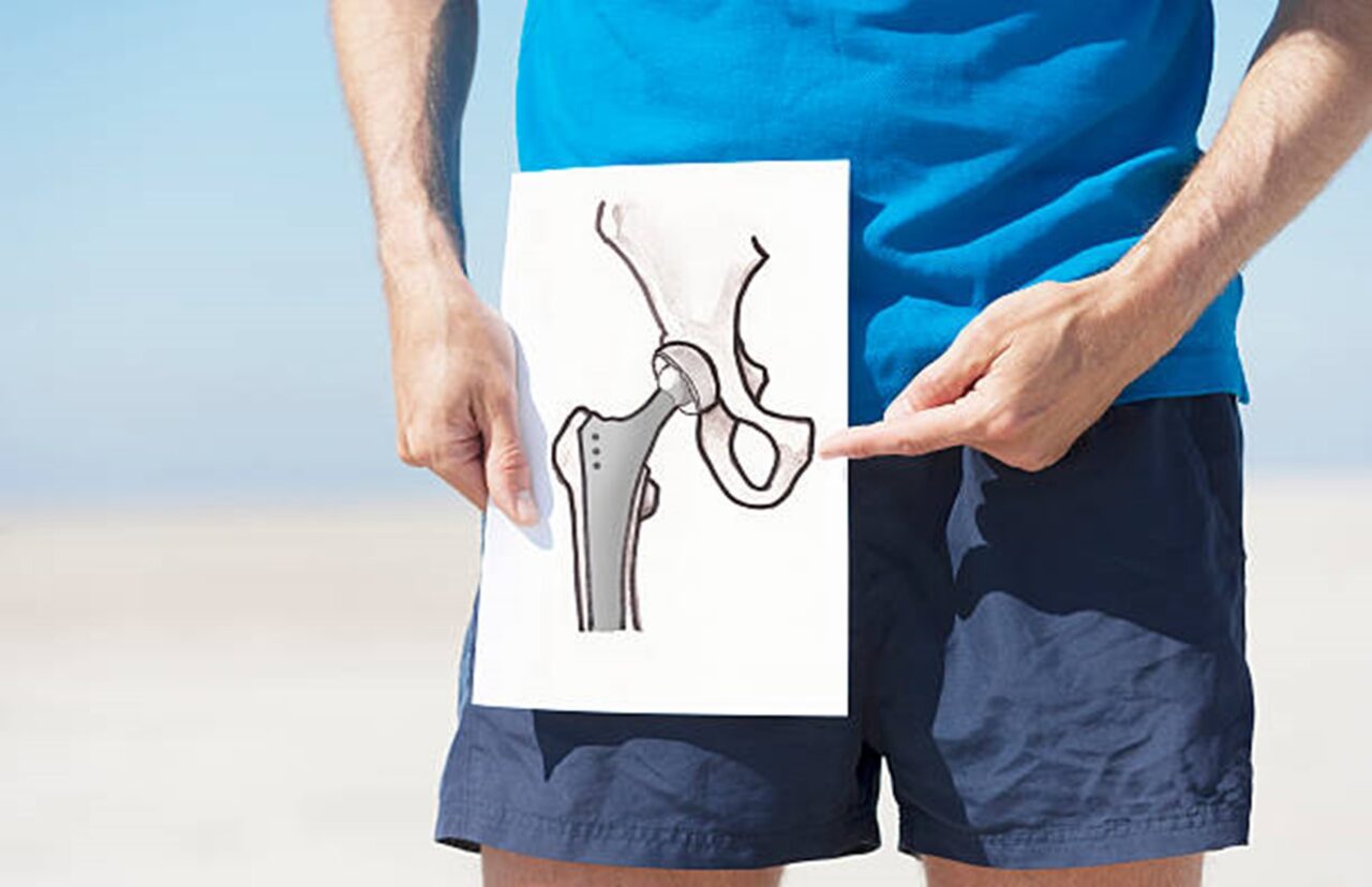 Managing Swelling 3 Months After Hip Replacement | Dr Sandeep Singh