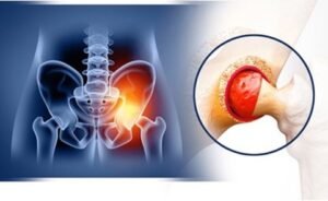 Managing Swelling 3 Months After Hip Replacement Dr Sandeep Singh Managing Swelling 3 Months After Hip Replacement Dr Sandeep Singh
