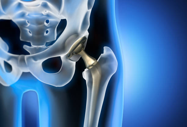 Dislocation after Hip Replacement