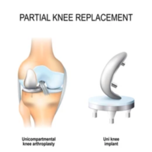 How is Partial Knee Replacement Different from Total Knee Replacement?