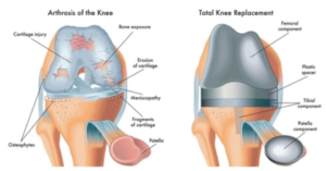 Total Knee Replacement (TKR)