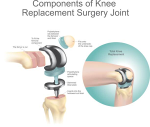 What is Knee Replacement Surgery?