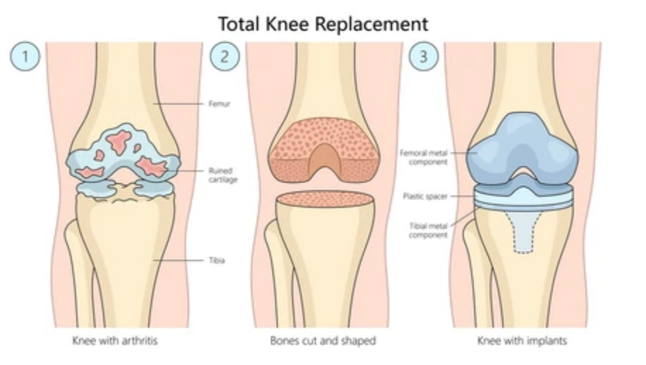 What should I expect during the recovery process after total knee arthroplasty?