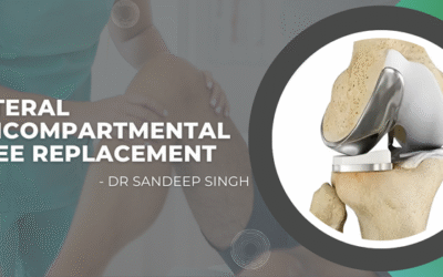 Lateral Unicompartmental Knee Replacement