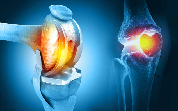Knee replacement