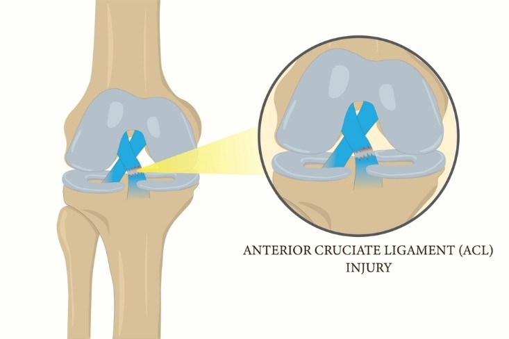 Knee Replacement