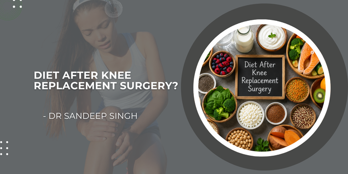 Diet After Knee Replacement Surgery
