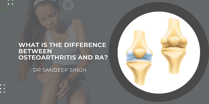 What is the Difference Between Osteoarthritis and RA