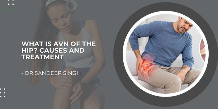 What Is AVN of the Hip? Causes and TreatmentWhat Is AVN of the Hip? Causes and Treatment